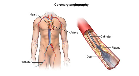 coronary-angiography-doctor