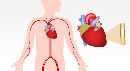 coronary-angioplasty-doctor