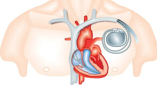 pacemaker-implantation-doctor