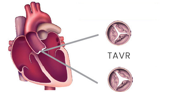 tavr-specialist